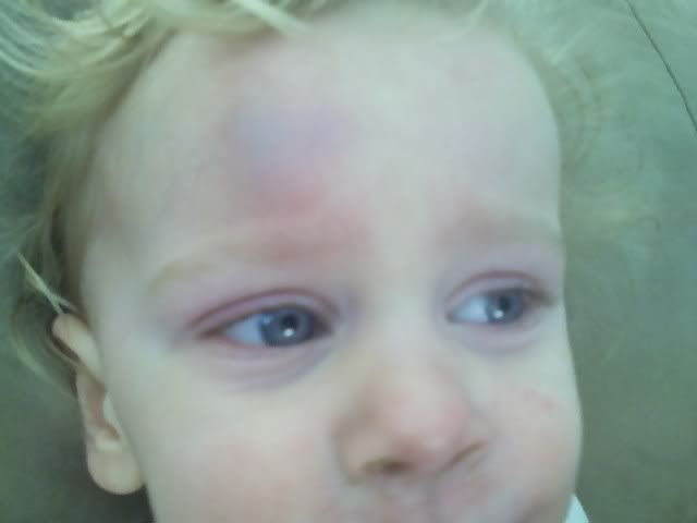 Bump on the head